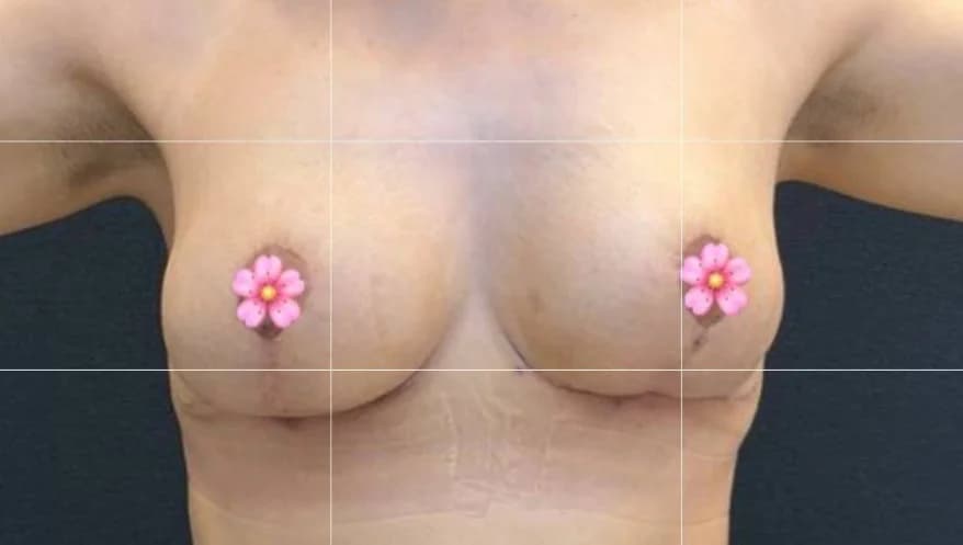 لیفت سینه (اتوپروتز) — بعد