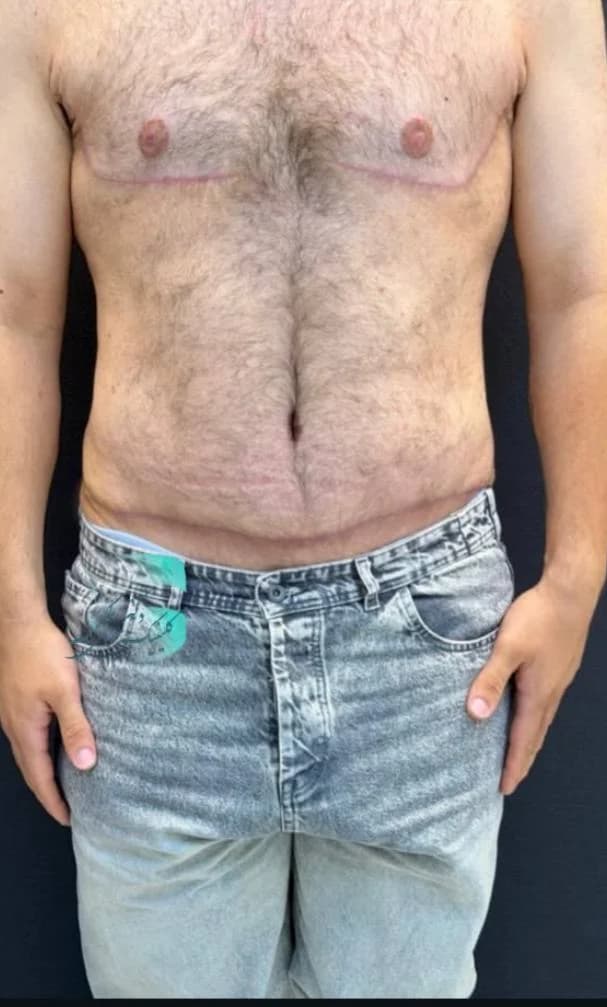 اصلاح ژنیکوماستی — بعد