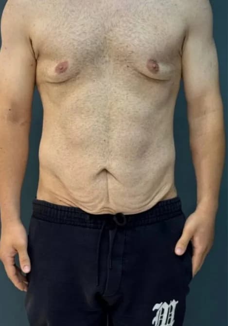 اصلاح ژنیکوماستی — قبل